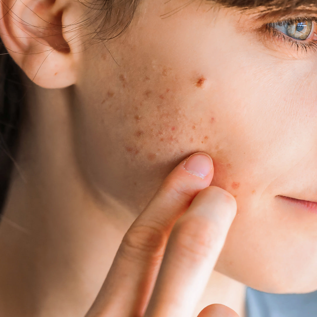 Salbe mit 9,8% Ichthyol (MD01B)